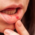 7 remedes de grand mere efficaces contre les boutons de fievre valides 1