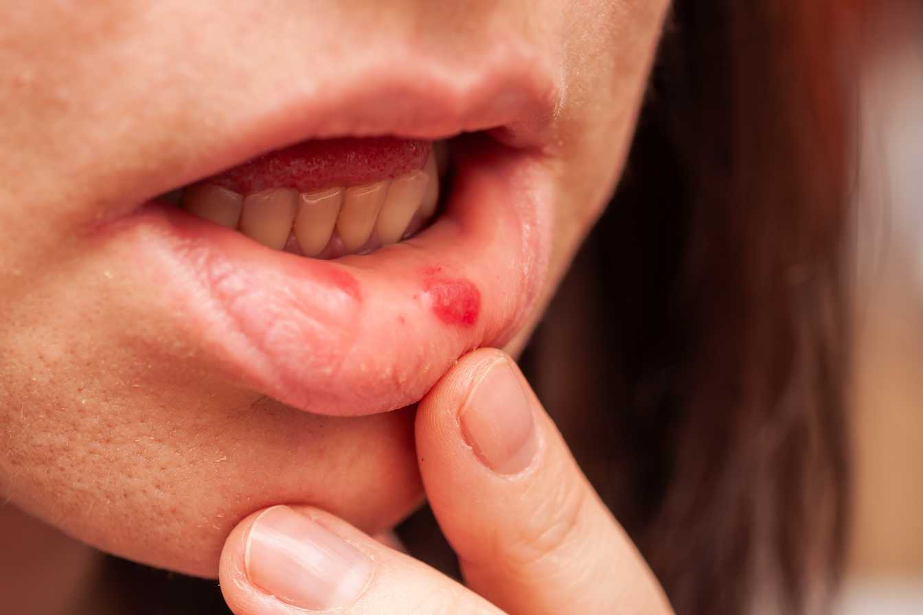 7 remedes de grand mere efficaces contre les boutons de fievre valides 1