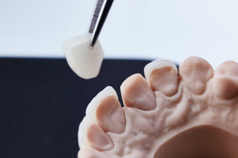 ceramique dentaire capdentaire 1